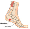 Plantarfasziitis Übungen